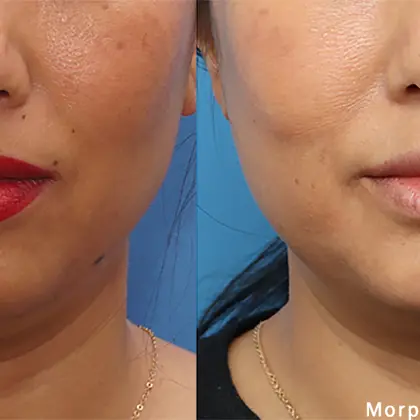 Morpheus8 Face Rwestreocj