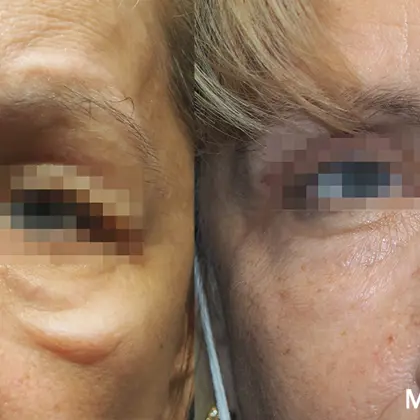 Morpheus8prime Malarbag Provatti