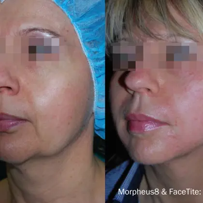 PR 1A Morpheus8facetite Scaled