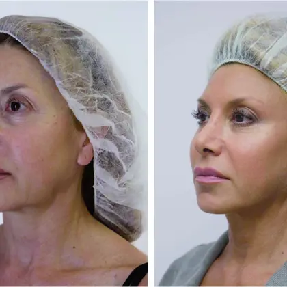 WOMEN BEFORE & After Copy