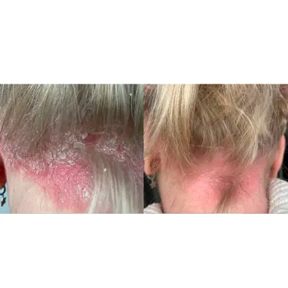 Before And After Red, NIR 15 Session 3 Weeks