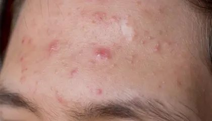 Acne