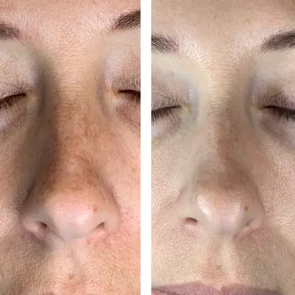 Reboot PEEL Nose Before And After