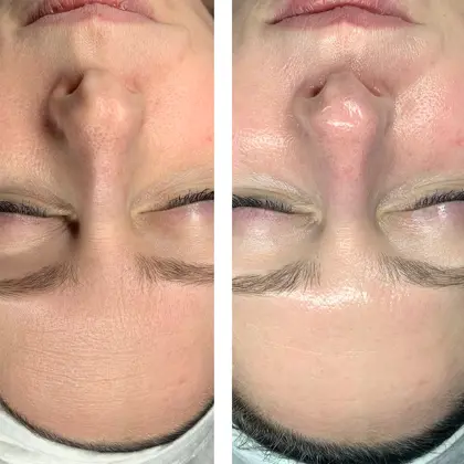 Fire Ice Before And After