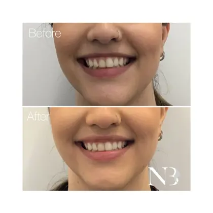 Before & Afters Dr Natasha 8