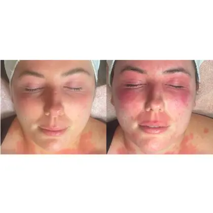 Before And After NIR 5 Sessions 2 Weeks