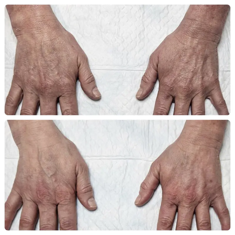 Hand Rejuvenation Before and After