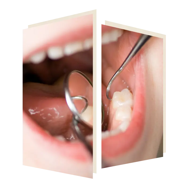 Tooth Restoration the Dental Studio at The Door W4