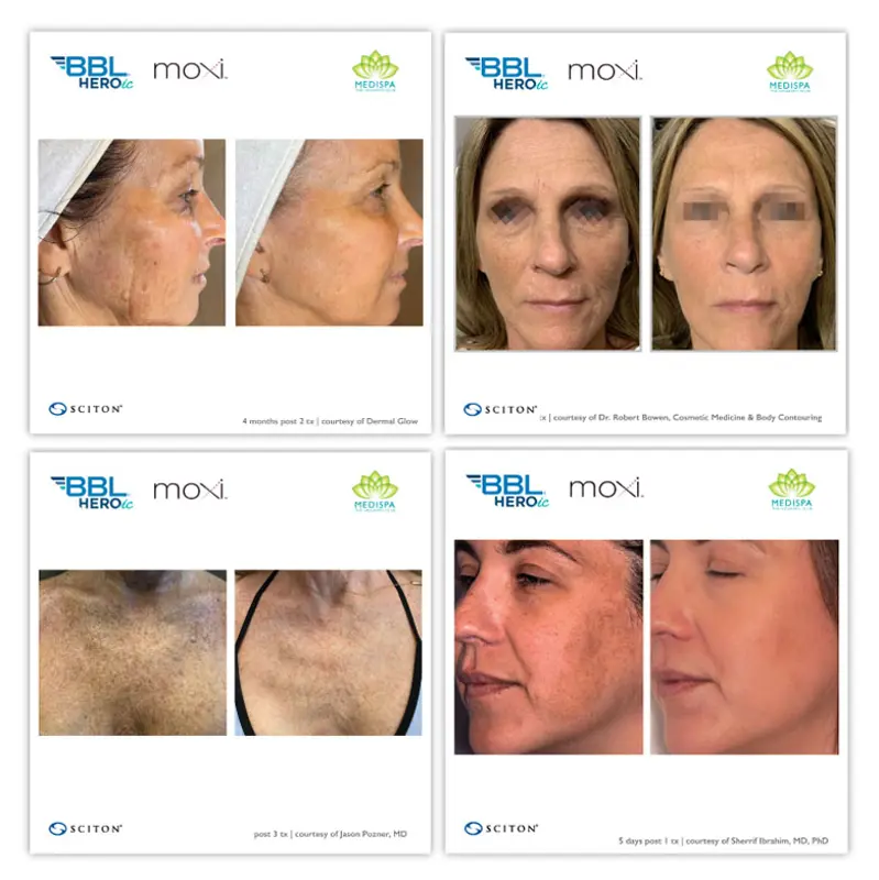 Before and after sciton treatments for skin rejuvenation