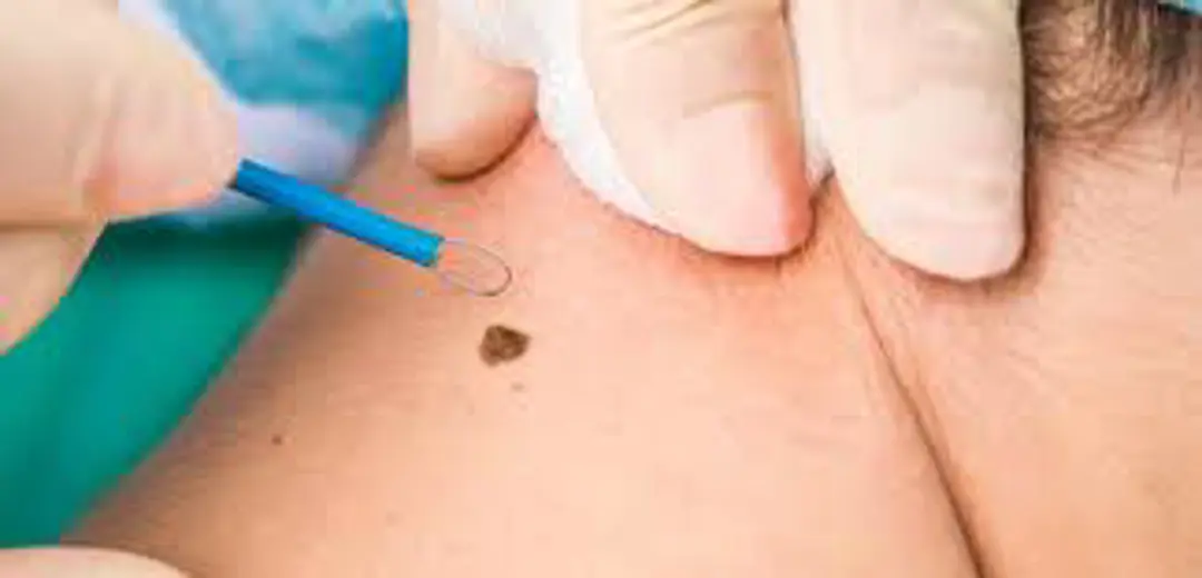 Skin Lesions: What Are They and How Can You Remove Them?