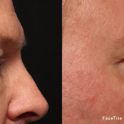 MC Facetitemorpheus8 1C Periorbitalrightprofile