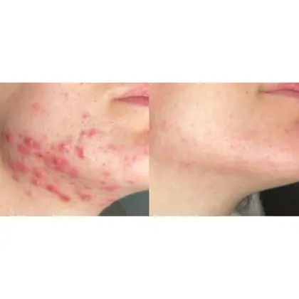 Before And After Blue, Red, NIR 16 Sessions 6 Weeks