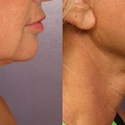 GS Morpheus8 1A Jowl