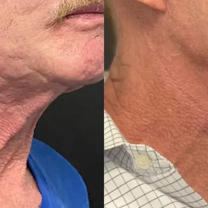 DP Morpheus8 1A Neckjawline