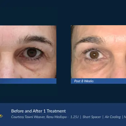 Agejet Before And Aftersagejet Eye Female Weaver