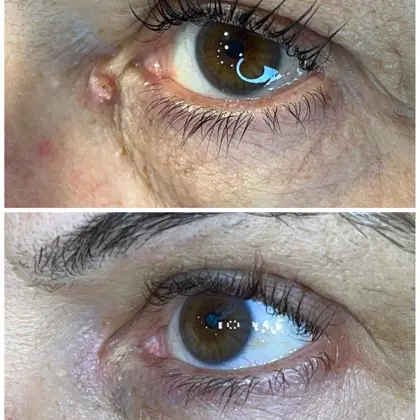 Medial Canthal Wart Removal With Plexr Sublimation Technology 1