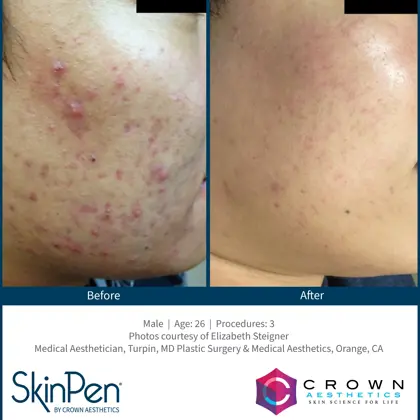 BA acne scars 2.jpg (1)