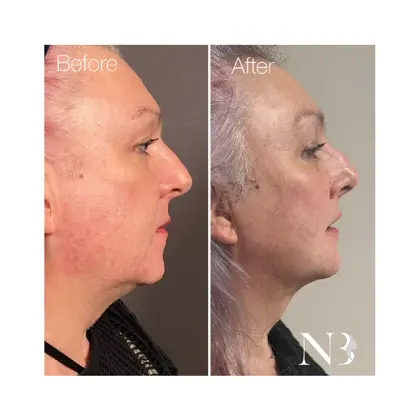Before & Afters Dr Natasha 2