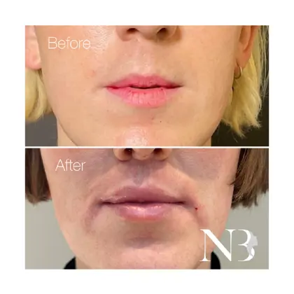 Before & Afters Dr Natasha 13