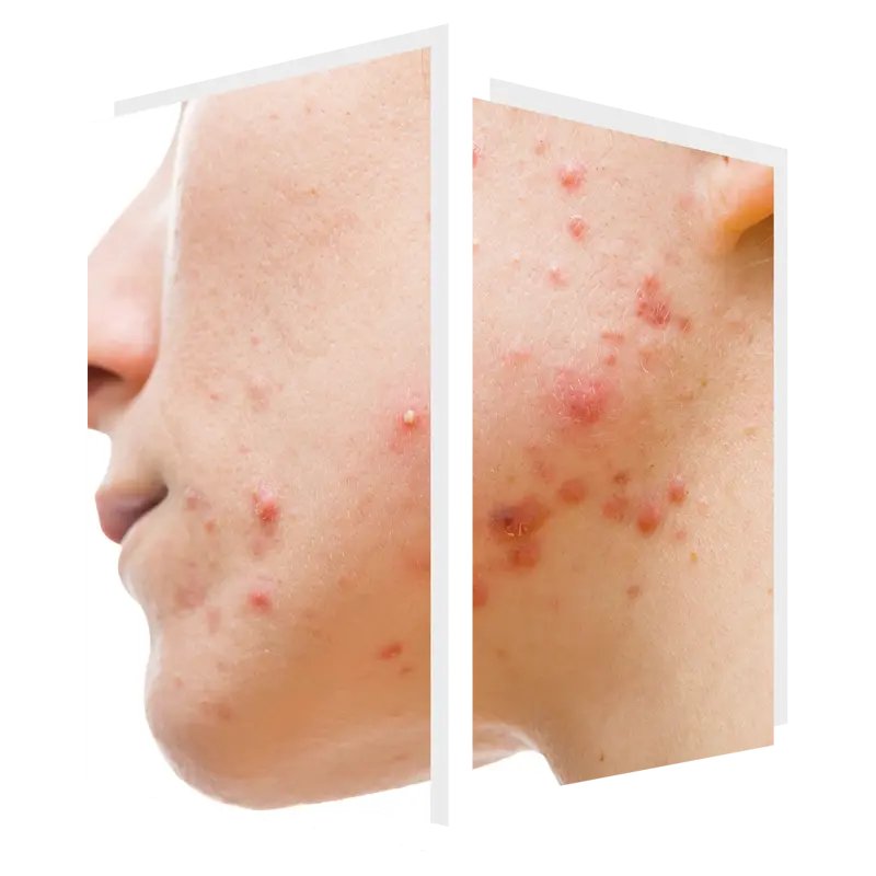 acne and acne scarring can be treated by ClearSkin laser at The Door W4