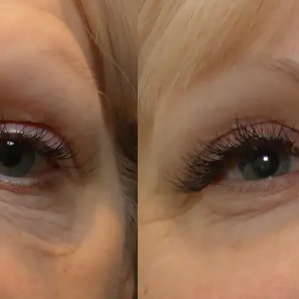 BF Morpheus8 1A Front