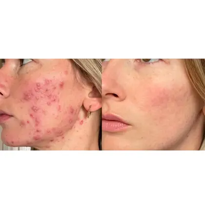 Before And After Blue, Red, NIR 12 Sessions 6 Weeks