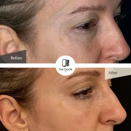 Kellie Before And After Polynucleotides 1 Copy