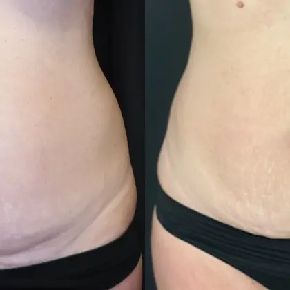 TS Bodytite 1A Abdomen