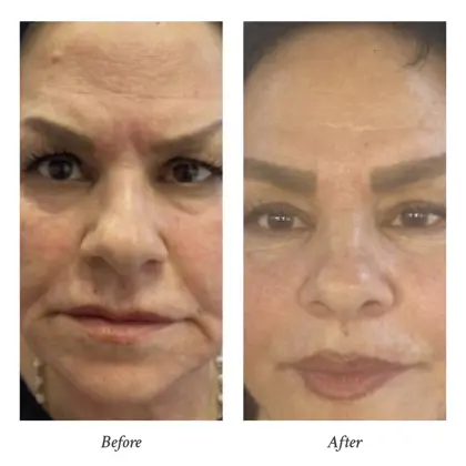 202603 Before and After (3) - Dr Kalin Tanov.jpg