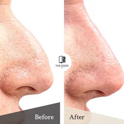 Non Surgical Rhinoplasty Before And Afters Copy