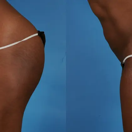 AT Bodytite 1C Abdomen