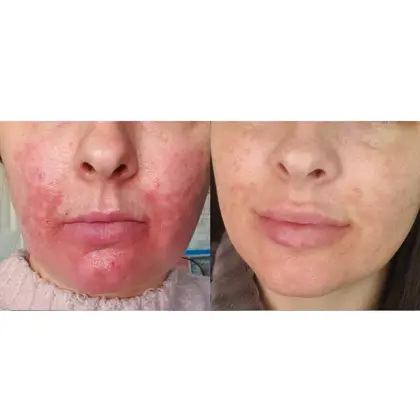 Before And After NIR 3 Sessions 3 Weeks