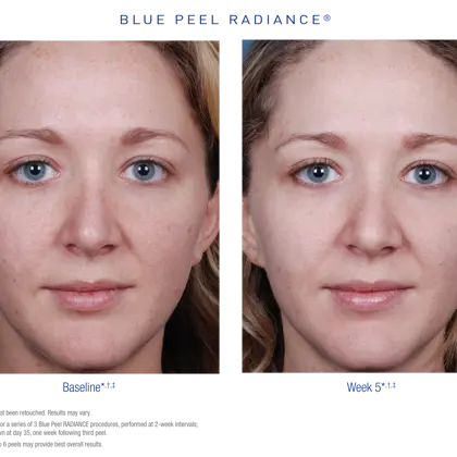 US BPR Before After 2 Small