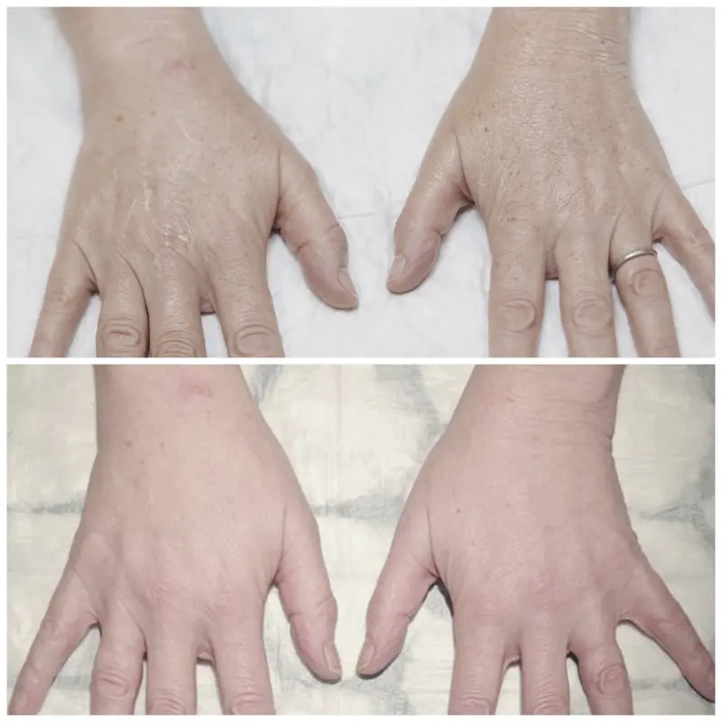 hand rejuvenation 4