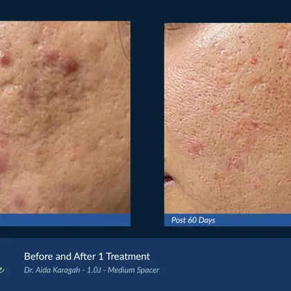 BA Agejet Acne Femaie Karagah