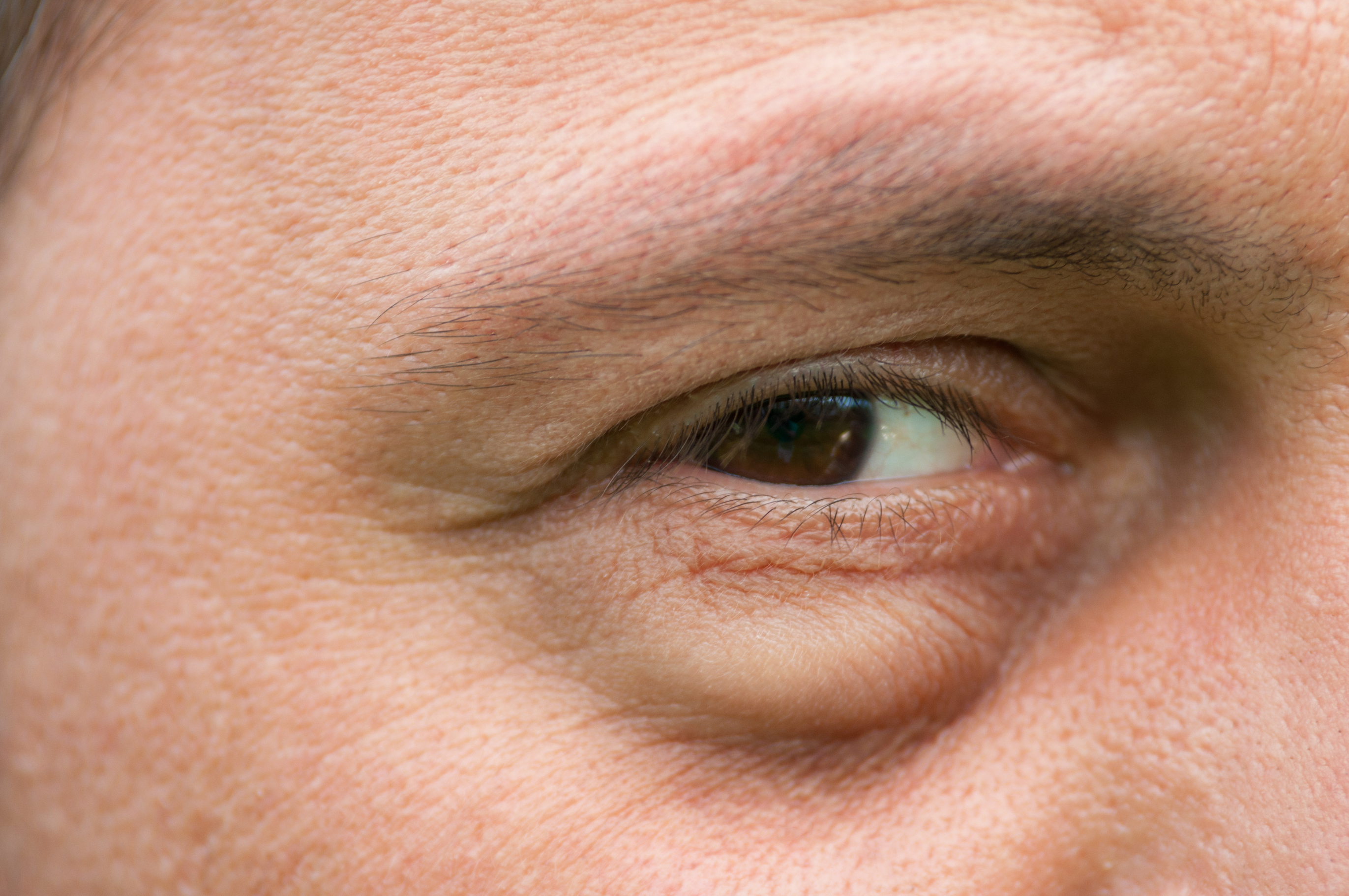 Dark and Puffy Under Eyes