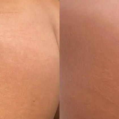 Sowa Morpheus8 1B Glutes