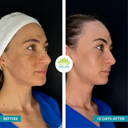 Before And After CORINA Moxi And BBL Heroic 01