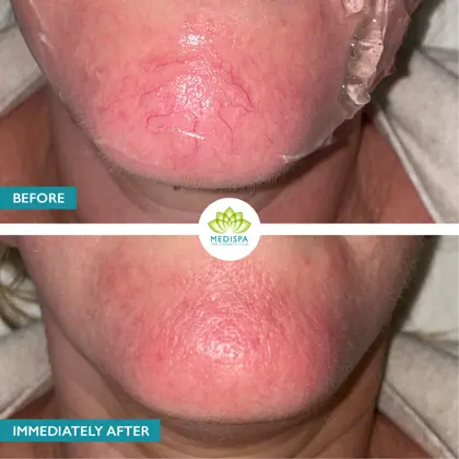 Before And After Red Vein Chin Immediately After BBL Hero