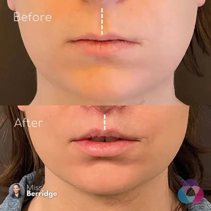 NB Before & After 1 (1)